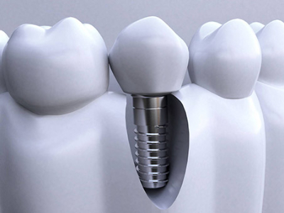 承德種植牙價格表，2024種植牙多少錢一顆呢?