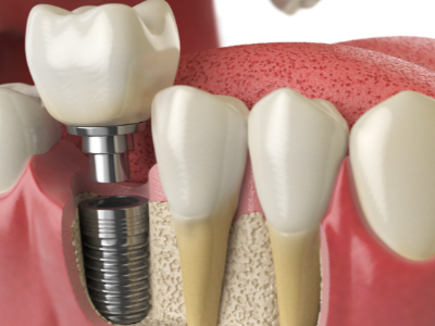 選擇種植牙后要做哪些日常維護(hù)？