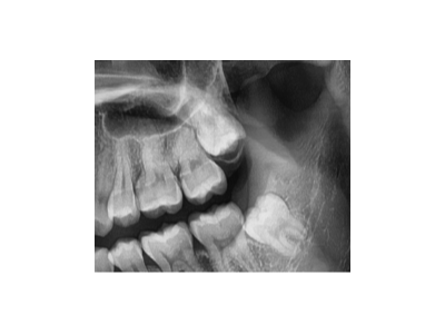 既然「智齒」不宜久留，為什么不能一次性拔掉？