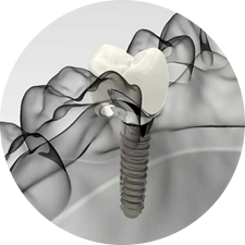 術(shù)前研究、模擬提升種植成功率