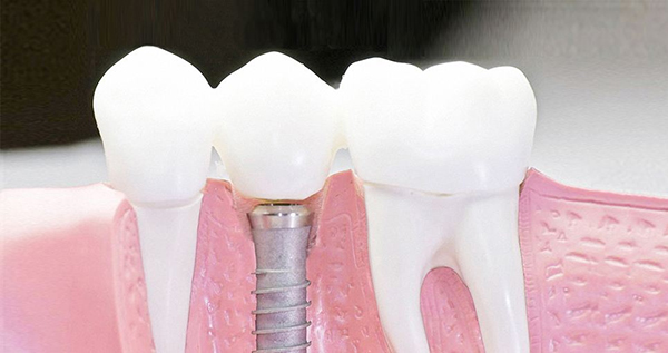 在承德口腔種植牙齒需要多少錢？惟德口腔一一為您道來